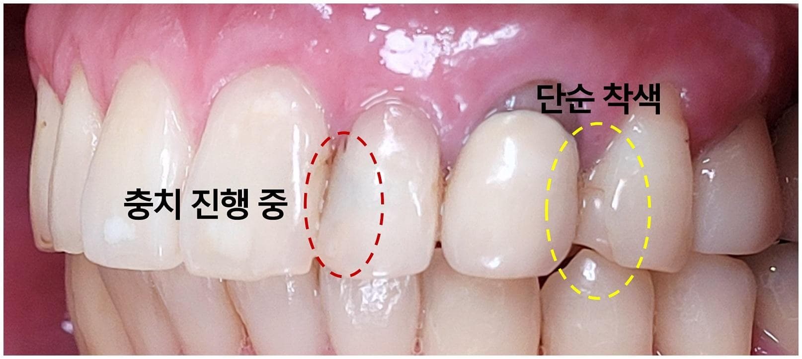 겉은 멀쩡한데 치아 사이에 충치가 생기나요 사진.